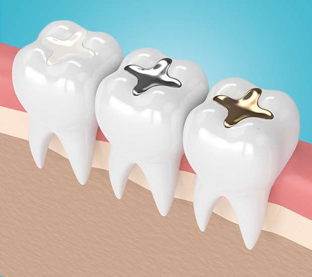 Atlanta Composite Fillings