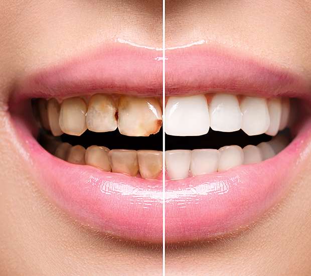 Atlanta Dental Implant Restoration