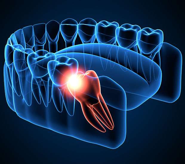 Atlanta Wisdom Teeth Extraction